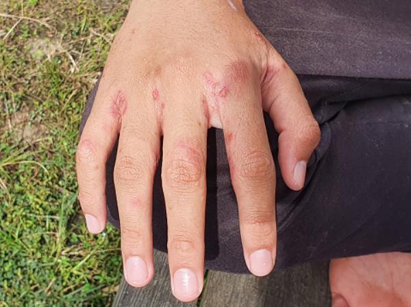 Close up of hand with with ulcer filled with pus co<em></em>ndition caused of scabies infection