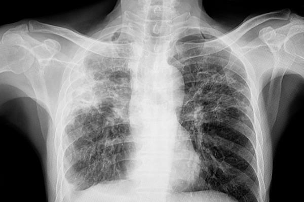 A chest xray of a patient with lungs tuberculosis shown in this photo. 