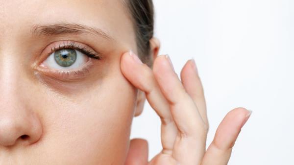 Dark circles — which tend to make you look older or more exhausted than you actually are — can be blamed on several factors, including genetics, fatigue, dehydration, stress, alcohol abuse, allergies, and smoking.