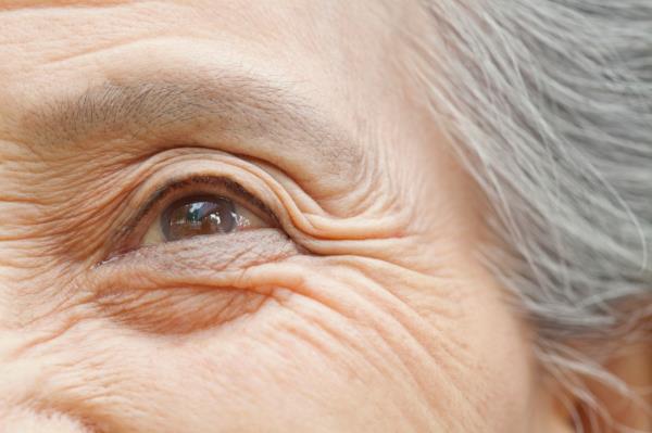 Crepey skin, which looks dry and wrinkled, can often be attributed to sun damage.