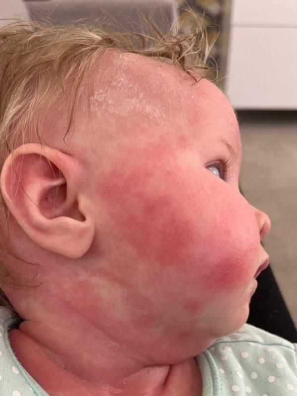 Baby Delilah with facial eczema