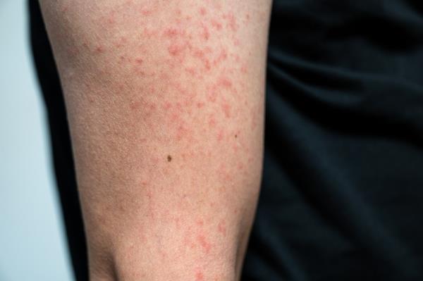 A red patchy rash on a person's arm shows one of the first signs of measles.