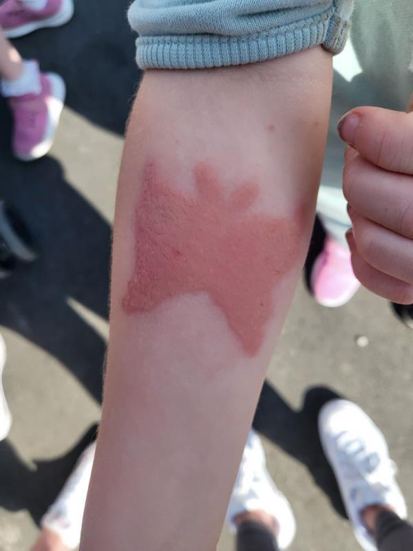 Photo of a young girl with a burn. 