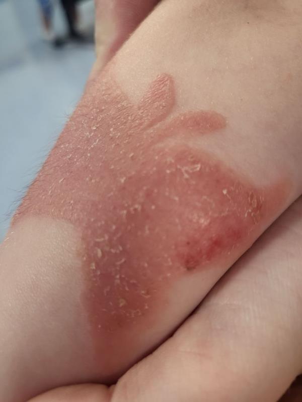 Photo of a child with a burn. 