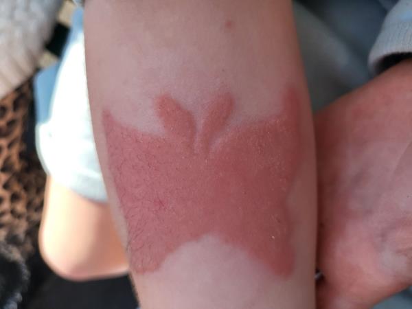 Photo of a burn tattoo. 