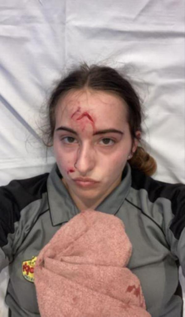 Her friends reacted quickly and called an ambulance after Ms Owen’s forehead began heavily bleeding from the bite.</p>

<p>　　